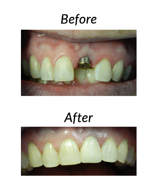 Mini Dental Implant Procedure