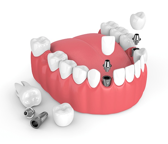 Dental Implants Solana Beach CA